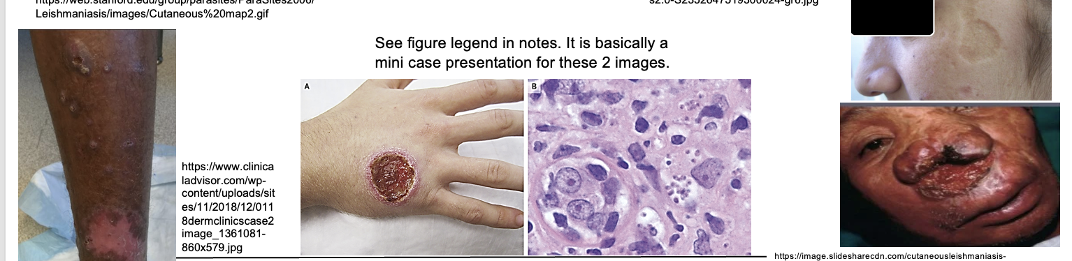 <p>An <strong>ulcer</strong> with raised edges = <strong>VOLCANO SIGN</strong></p>
