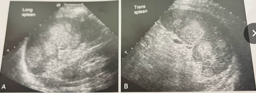 <p>A 44 year old woman presents w/RUQ discomfort and is referred for an abd. sonogram. Lab values were normal for hematocrit, RBC, WBC and platelet values. The pt reported absence of pain or discomfort on the lt side. This image demonstrates heterogeneity of the spleen owing to multiple hyperechoic lesions. What are the sonographic appearances and clinical hx most suggestive of?</p>