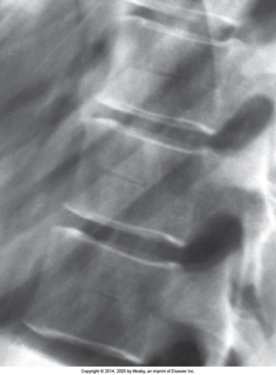 <p>Hahn Venous Clefts/Fissures are best seen in the _____ spine</p>