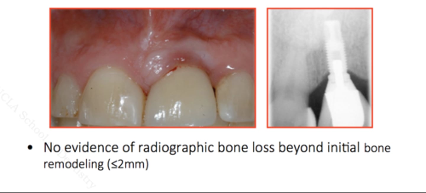 <p>- Inflammation of the peri-implant mucosa with no evidence of</p><p>progressing crestal bone loss</p><p>- Plaque-induced gingivitis with oedema</p><p>- Tissues will appear red and swollen and may bleed on gentle</p><p>palpation or probing; suppuration may also be visible</p><p>- Probing depths of 4mm or greater</p>