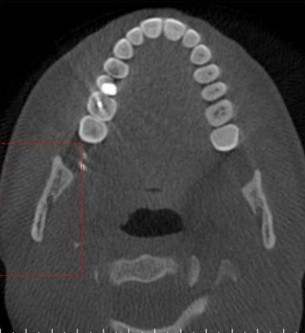 <p>what do you call the artifact seen here that causes alternating light and dark lines (not the metal) </p>