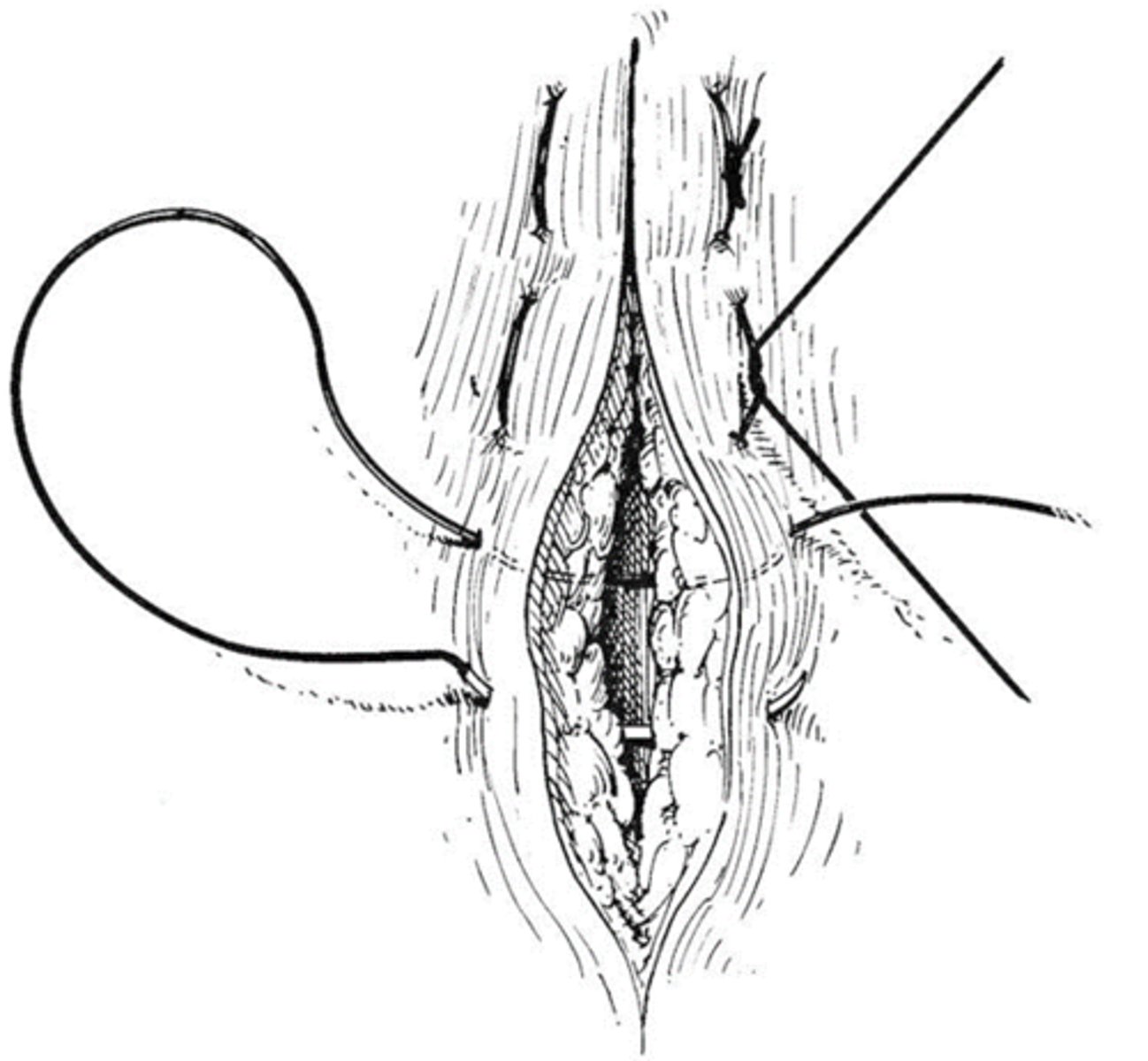 <p>tension relieving pattern, distributes forces away from the incision, too much tension will cause tissue to evert and damage blood supply to incision</p>