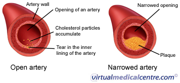 <ul><li><p>transports cholesterol from the liver to the body</p></li><li><p>the bad type, sticks to artery walls and can cause blood clots</p></li></ul>