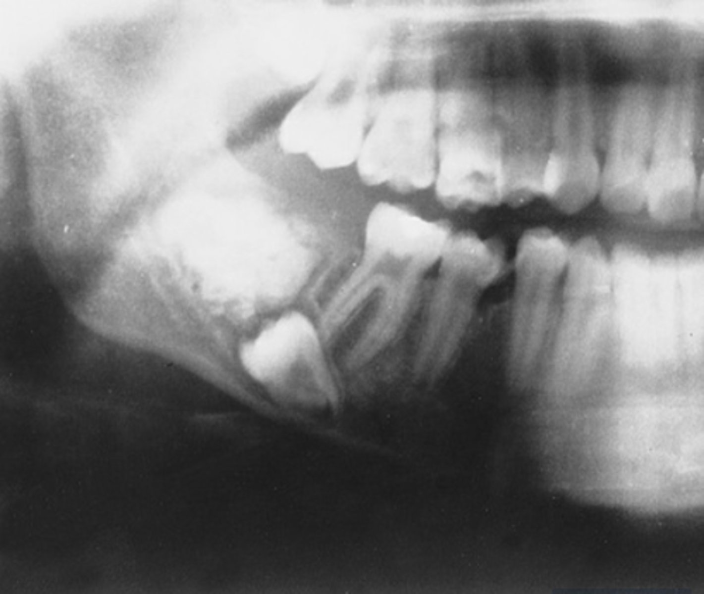 <p>posterior jaws</p>