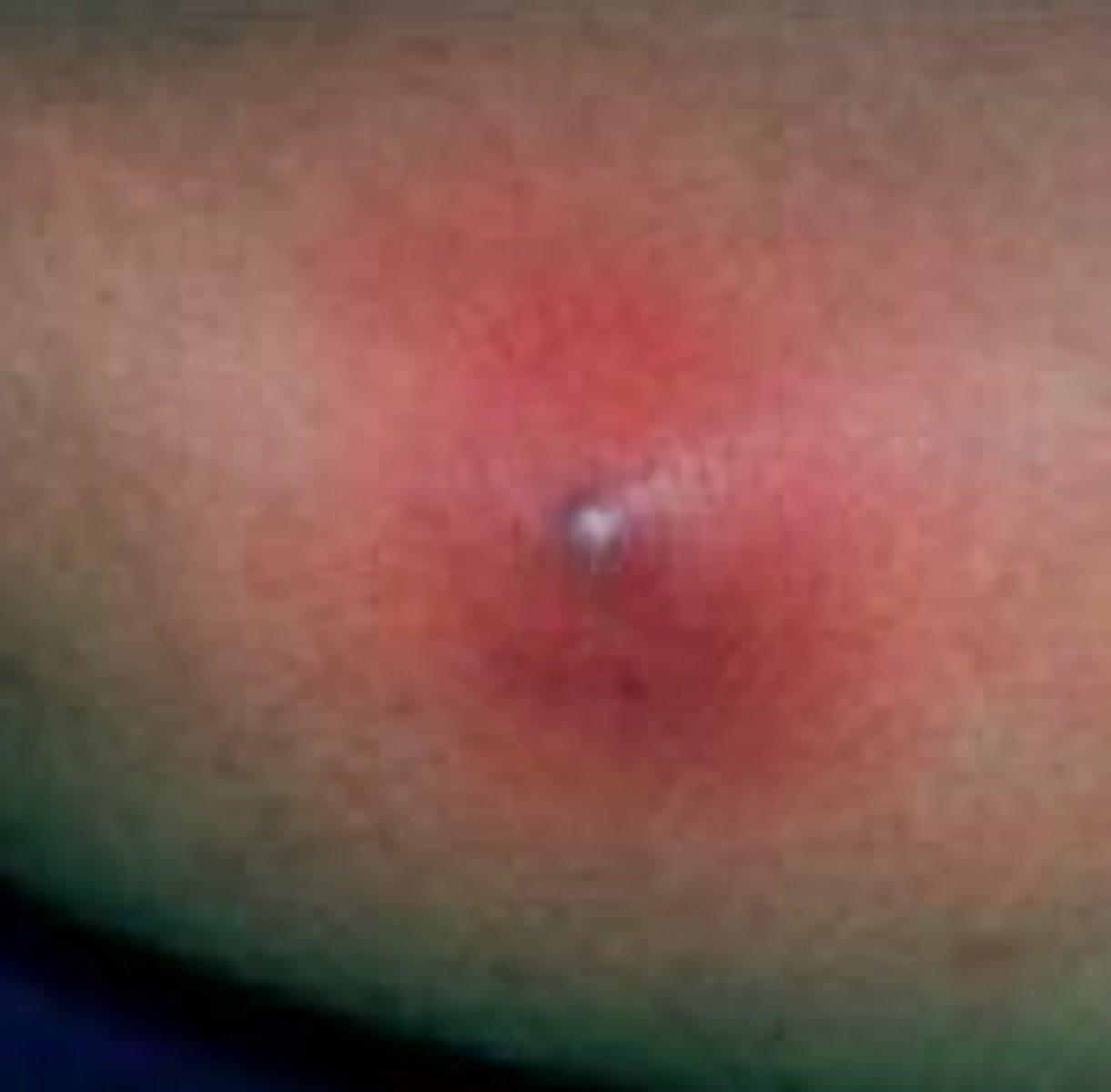 <p>pus; <strong>Furuncle (Boils) & Carbuncle</strong></p>