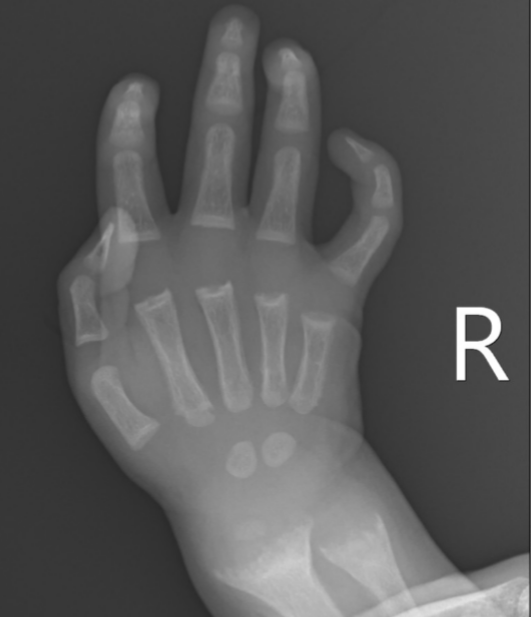 <p>What is the most common form of rickets pathologically?</p>