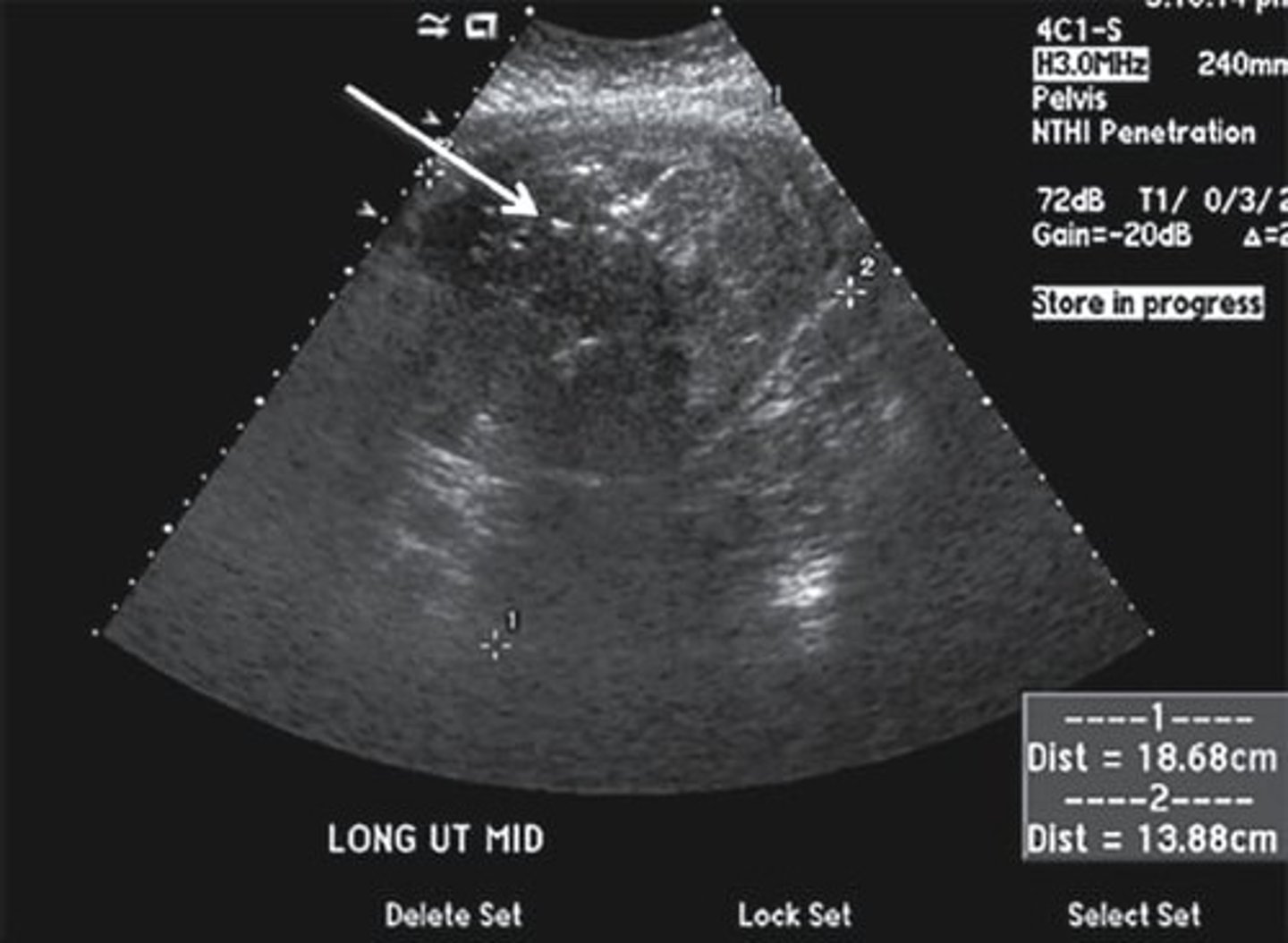 <p>- irregular endo</p><p>- possible fluid</p><p>- gas with ring down</p><p>- hyperemic</p>