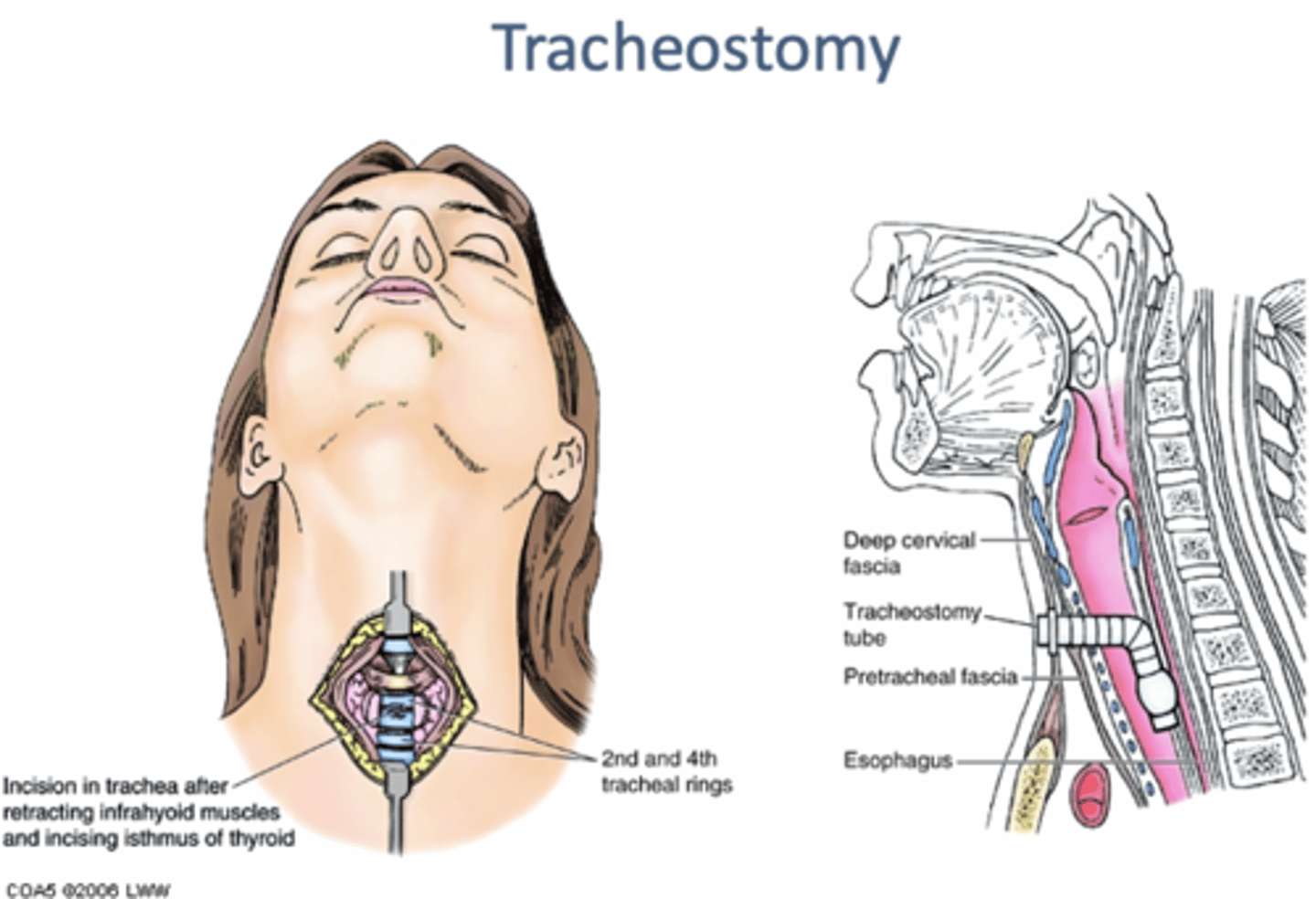 <p>making an opening of anterior wall of trachea</p><p>-airway in patients with upper airway obstruction</p><p>-incision can be made above, thru, or below isthmus of thyroid gland</p>