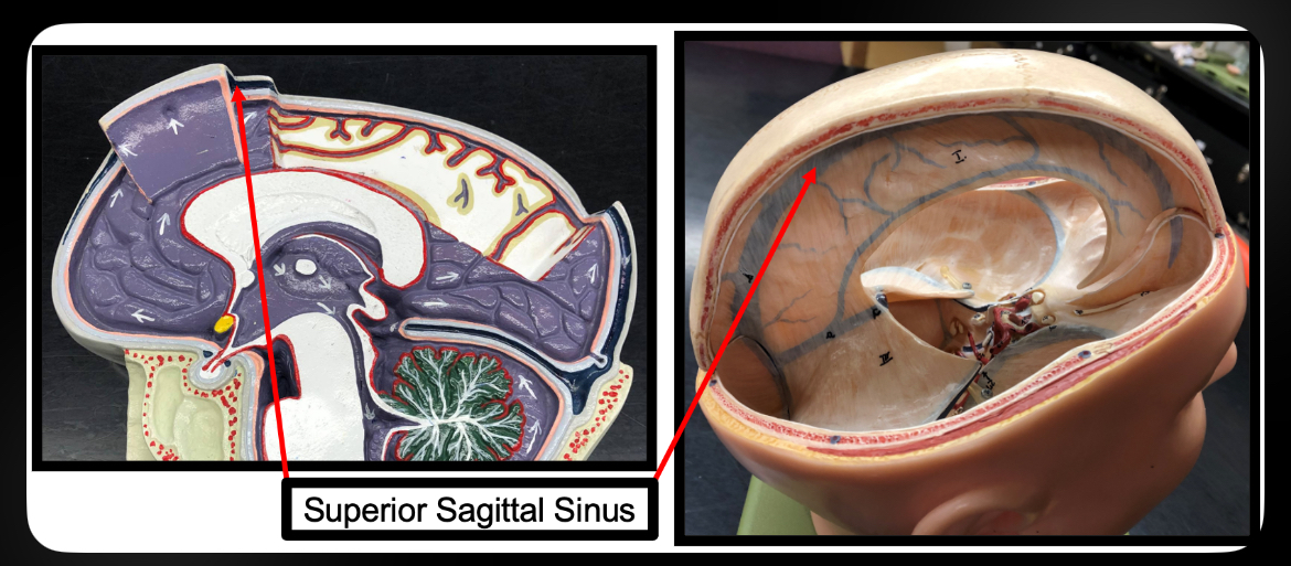 <p>Superior Sagittal Sinus</p>