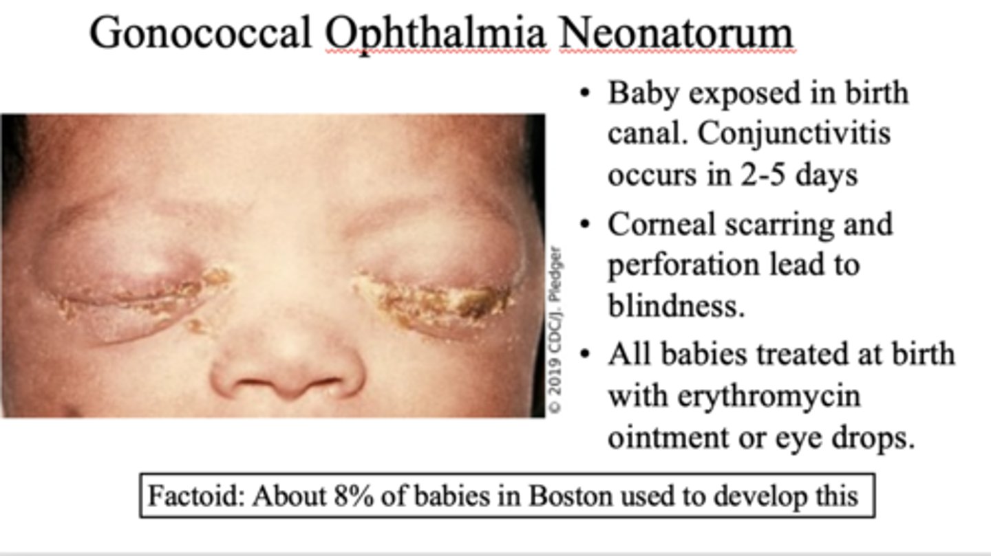 <p>gonococcal ophthalmia neonatorum</p>