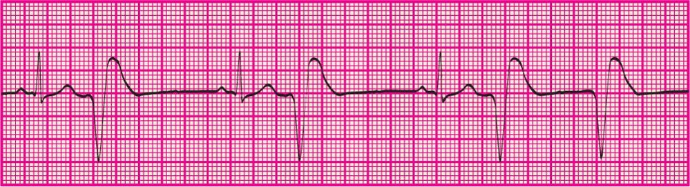 <p>Six or more PVCs per minute</p>