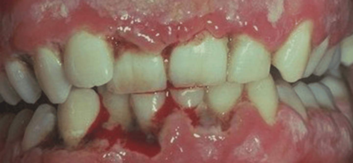 <p>gingivitis that progresses to attachment loss</p>
