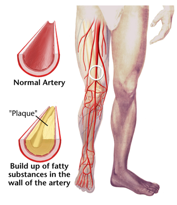 <p>thickening of artery walls causing hardening and loss of elasticity</p>