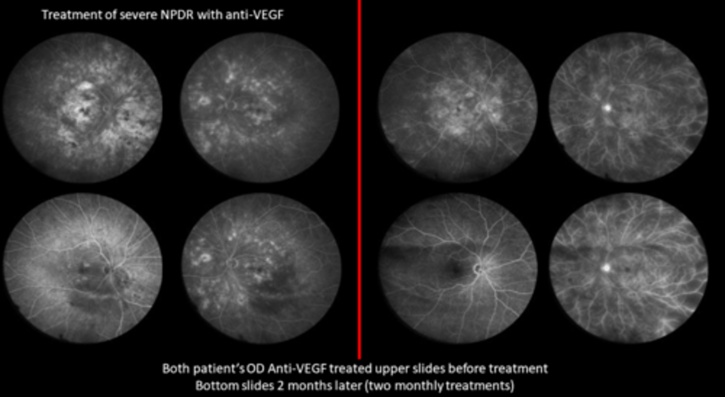 <p>What does Protocol S suggest for treating PDR with Lucentis?</p>