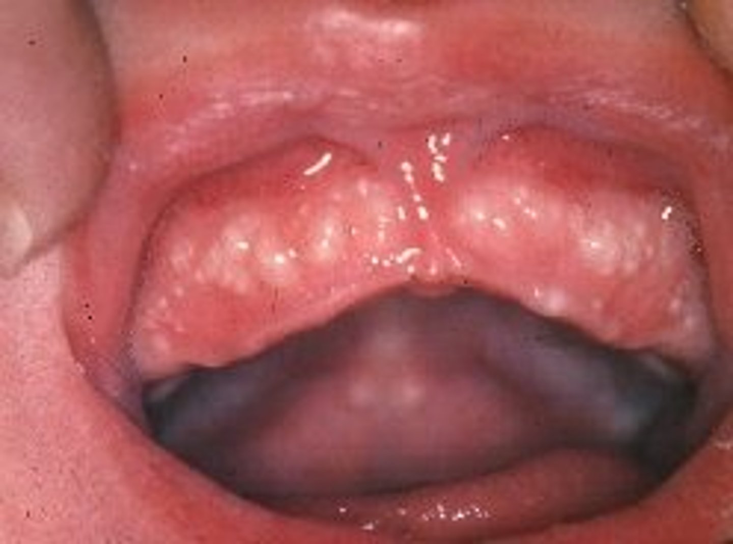 <p>white pearl like cysts on gum and palate that are benign and usually go away within a few weeks</p>