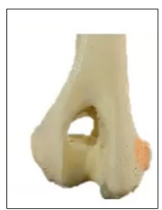 <p>• Medial side of the humeral condyle</p><p>• Attachment of the flexors of the forearm</p><p>• Flexors epicondyle</p>