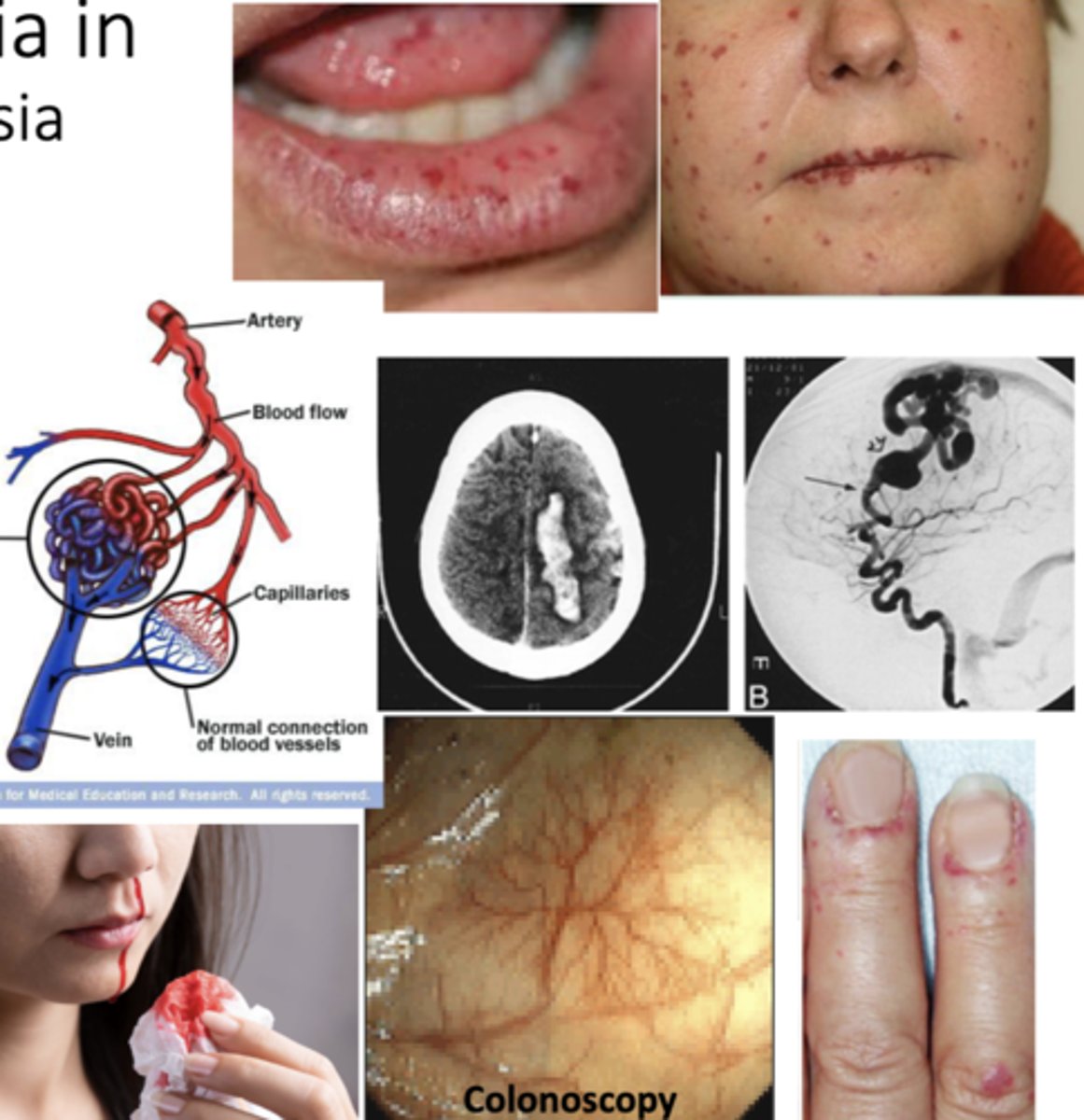 <p>small, dilated blood vessel near surface of skin/mucous membranes.</p><p>*common on lips, tongue, face, chest, fingers, GI tract</p>