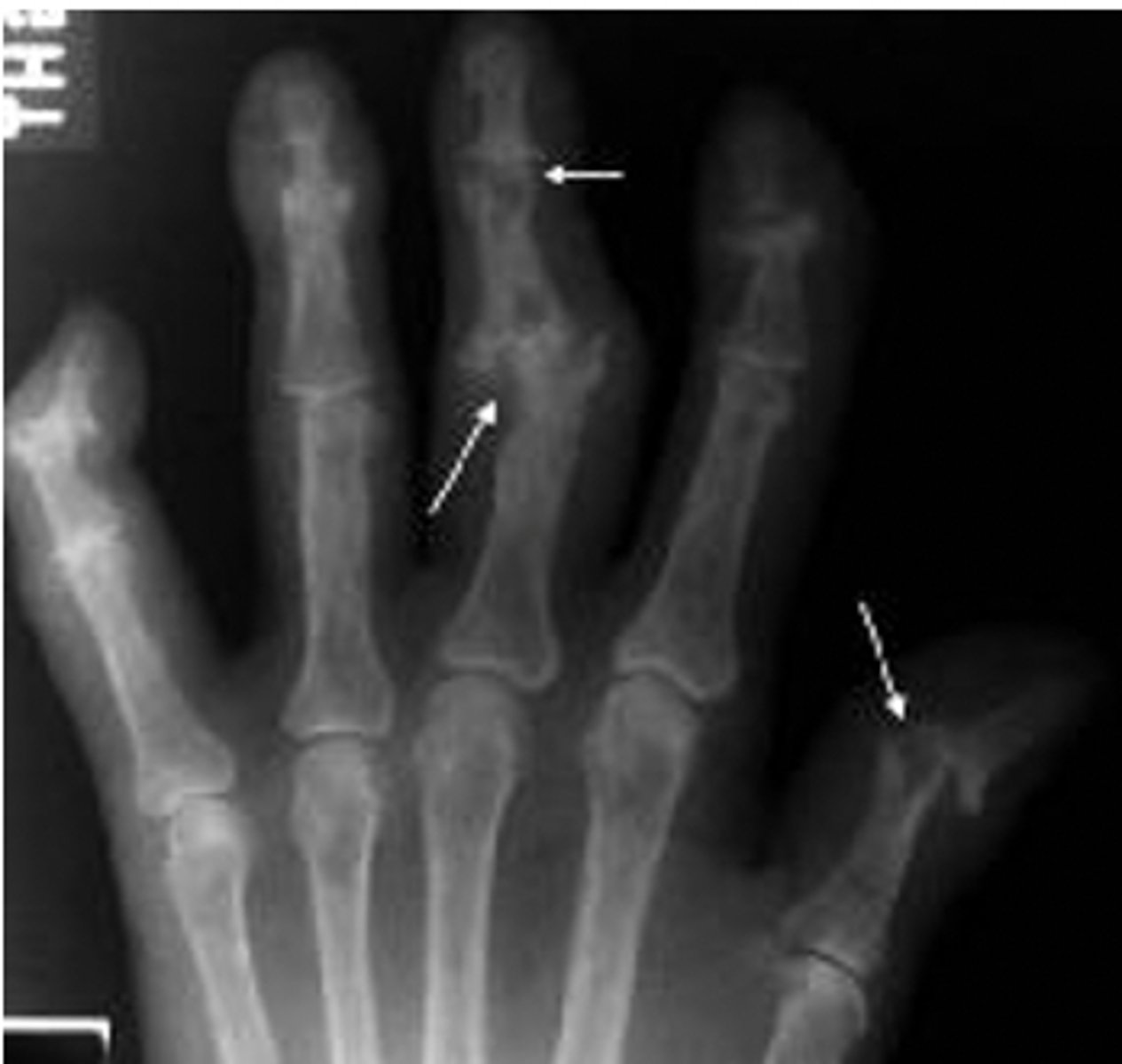 <p><strong>subperiostal resorption</strong> typically seen at radial aspect of the middle phalanx of the index and middle fingers</p>