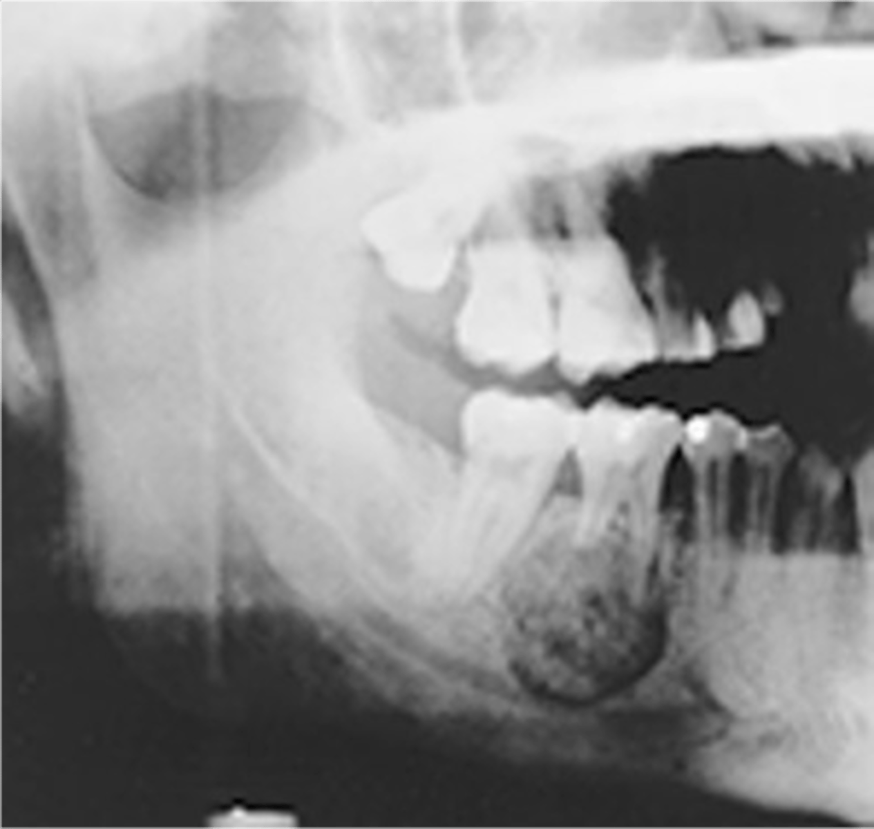 <p>Odontogenic tumor of cementoblasts that resembles another odontogenic tumor but has direct attachment to a tooth</p>