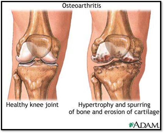 <p><u><span>Arthritis and connective tissue diseases</span></u><span>: Osteoarthritis causes</span></p>