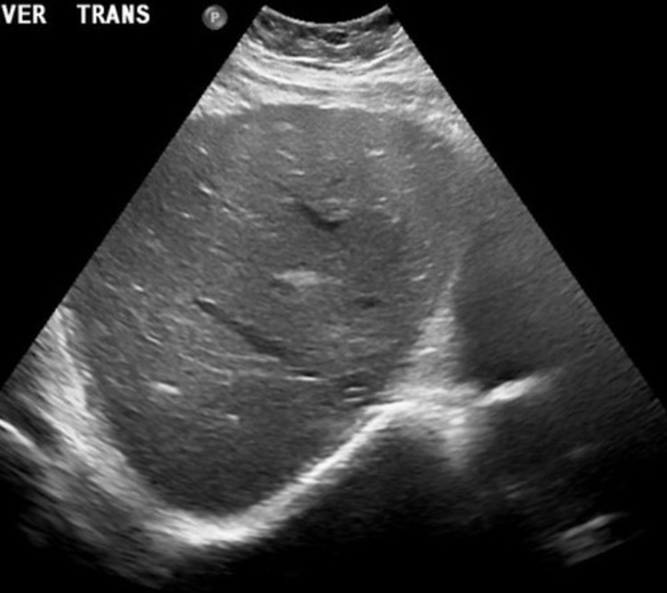 <p>Decreased liver size</p><p>Hypertrophied caudate lobe</p><p>Surface nodularity</p><p>Portal HTN</p>
