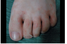 skin infection