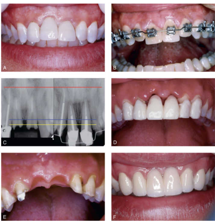 <p>as teeth are extruded, apposition of bone occurs at the root apex, thereby filling the socket w bone as the tooth is slowly ext orthodontically </p>