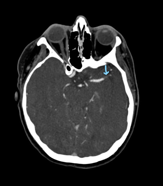 <p>To evaluate the arterial and venous blood supply of the brain, especially in acute neurological emergencies.</p>
