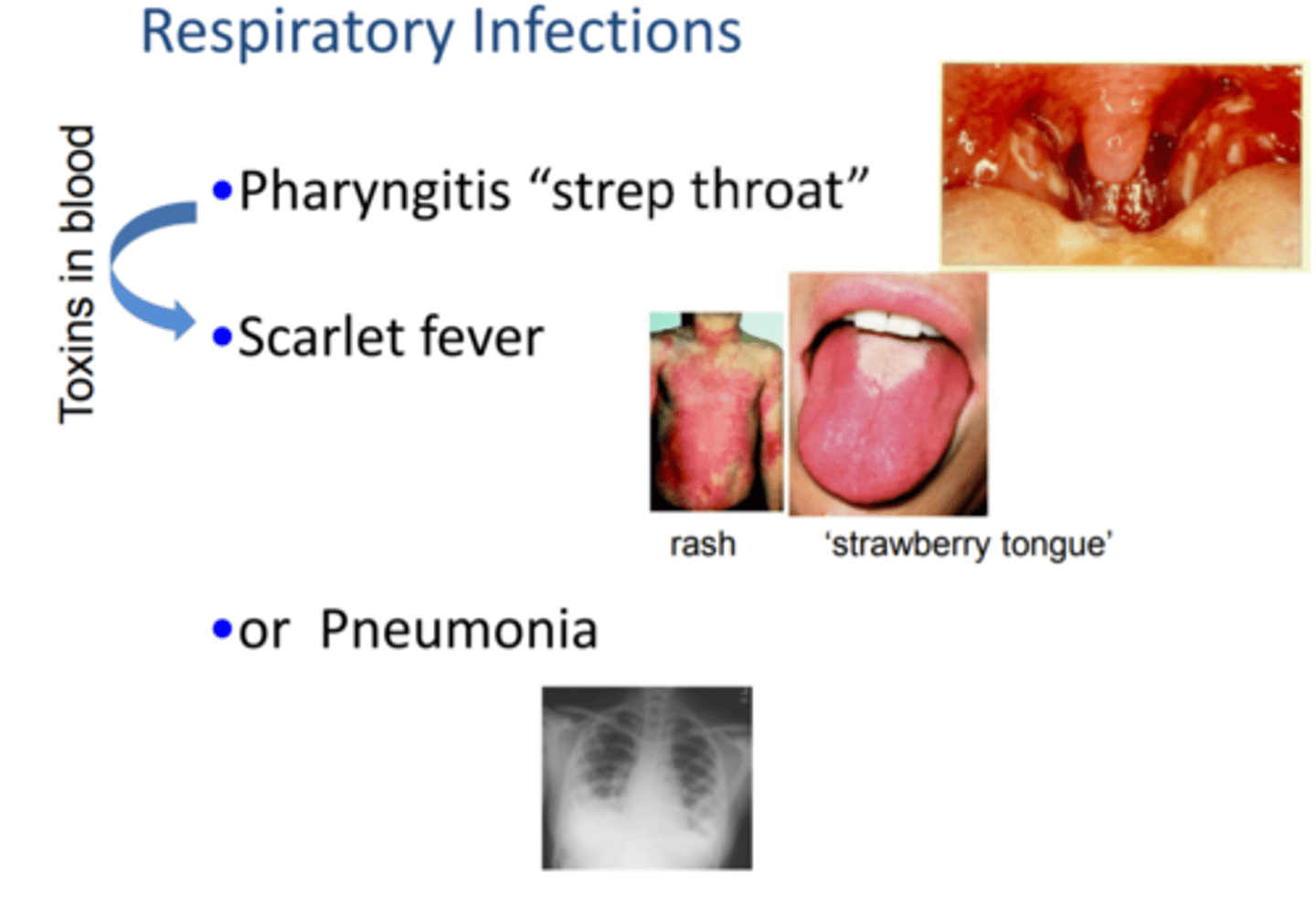 <p>Strep Throat </p><p>-which leads to scarlet fever when toxin (SpeA or Spec) from bacteria is released in blood </p><p>-Pneumonia (more fatal but less common than infection from Strep pneumonia) </p>