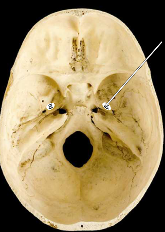 <p><strong>Foramen ovale of sphenoid bone</strong></p>