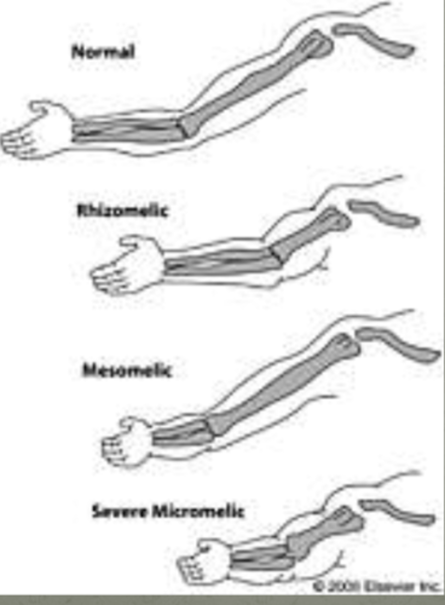 <p>rhizomelic</p><p>mesomelic</p><p>acromelic</p><p>micromelic</p>