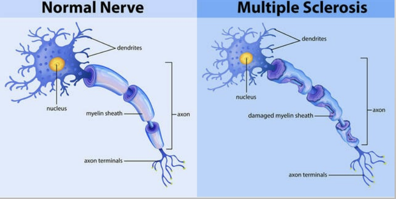 <ul><li><p>the loss of myelin sheaths in the CNS neurons: multiple sclerosis</p></li><li><p>the loss of myelin sheaths in the PNS neurons: guillian-barre syndrome</p></li><li><p>autoimmune diseases: the immune system attacks itself and destroys myelin sheaths </p></li><li><p>neuron function is impaired (sensory & motor) </p></li></ul><p></p>