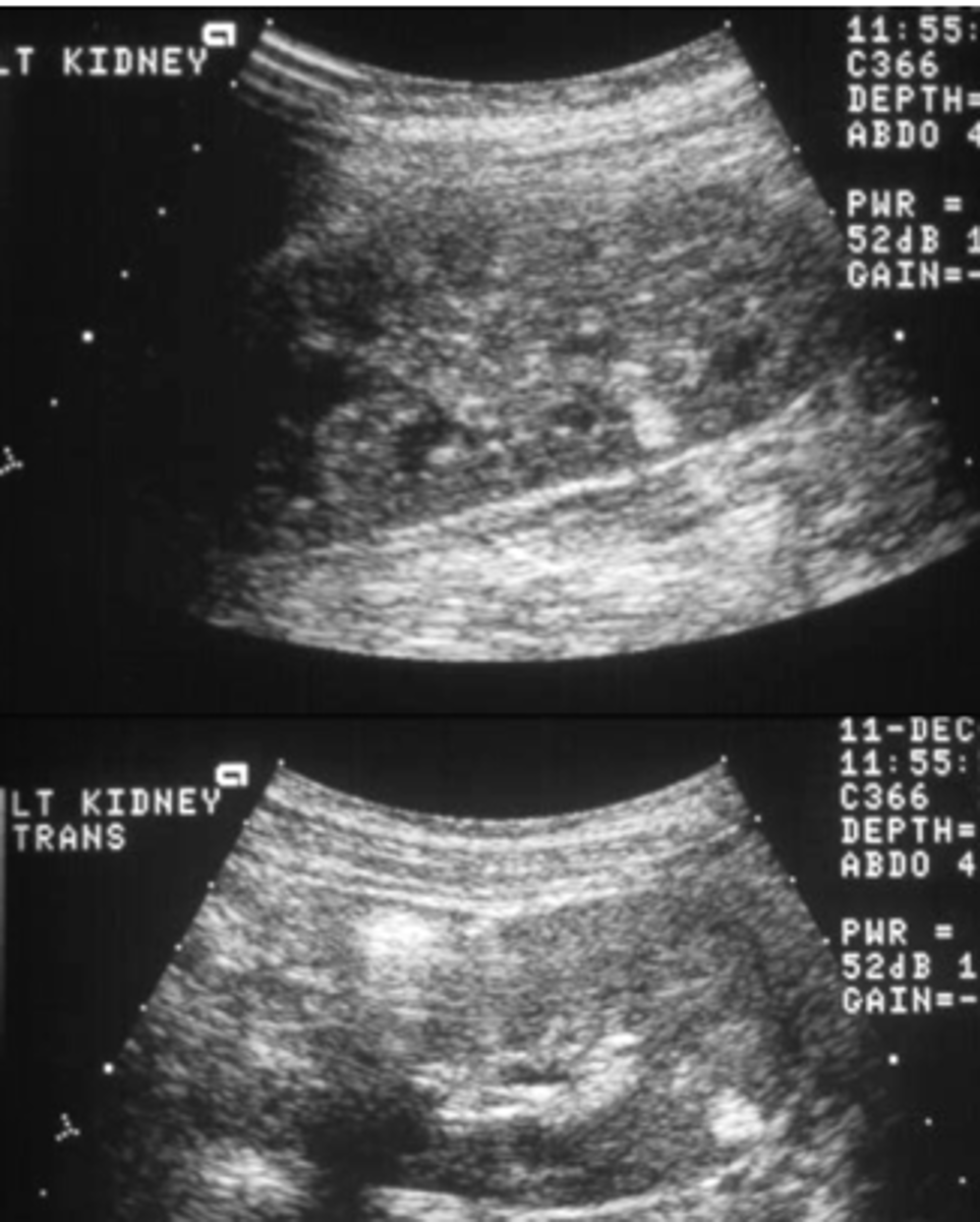 <p>Oncocytoma- spokes on a wheel, central scar artifact</p><p>Lipoma- fatty tumor located just below the skin</p>