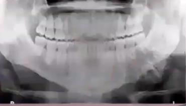 <p>how would you describe this lesion</p>