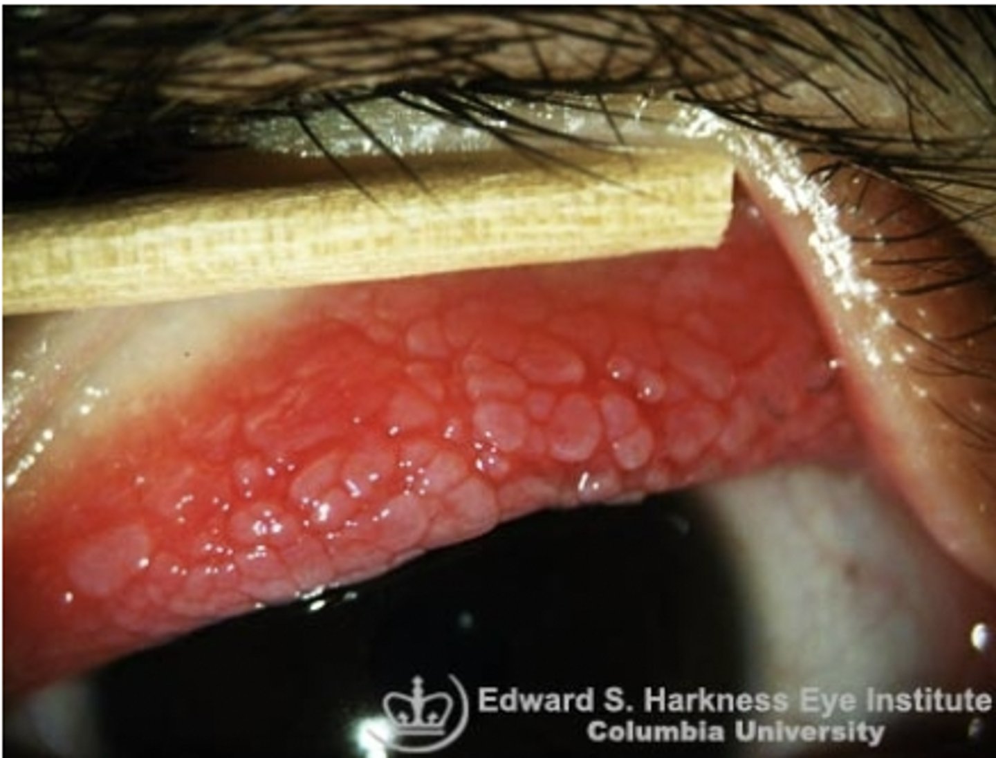 <p><u>Etio:</u> allergic conjunctivitis w/ <strong>cobblestone upper tarsal</strong> conjunctiva</p><p><u>Risk Factors: </u>Chronic seasonal allergies</p><p><u>S&amp;S:</u> Watery <strong>mucoid discharge, FB sensation, itching</strong>, burning, no visual symptoms, <strong>large "cobblestone" papillae</strong> </p><p><u>Tx:</u> <strong>Cromolyn sodium 4% solution</strong>, referral - ophthalmologist routinely, possible allergist if chronic allergies cannot be controlled, no contacts during tx</p>