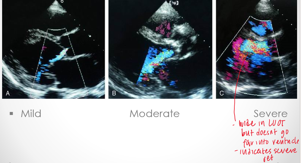 <p>jet / LVOT width</p><ul><li><p>measure percentage of the left ventricular outflow tract occupied by the ai jet&nbsp;</p></li><li><p>assess how far AI is going into the LV&nbsp;</p></li></ul><p></p>