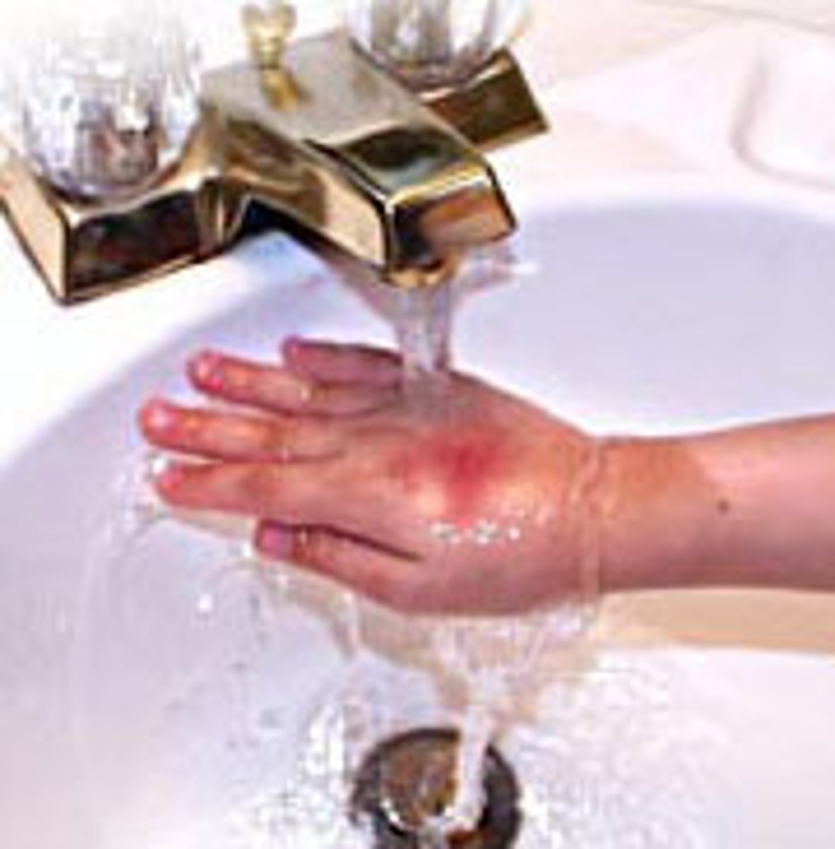 <p>apply cool water until pain stops, apply moisturizing lotion</p>