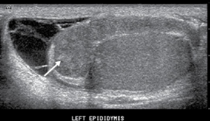 <p>sono appearance of epididymo-orchitis</p>