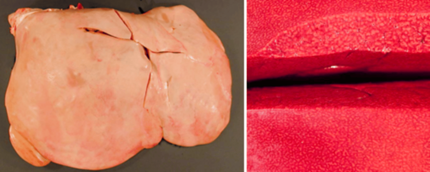 <p>Lever fra okse, hvad er den patoanatomiske diagnose?</p>