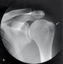 <p>name the projection and rotational; label the part of the humerus the arrow is pointing to </p>