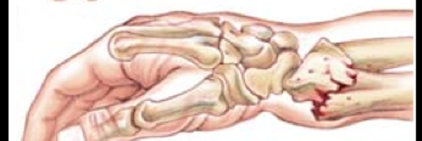 <p>- fracture of the distal radius and ulna</p><p>- commonly FOOSH</p>