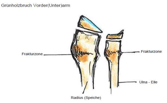 <p>Kindliche Knochenbrüche</p><p></p><p></p>