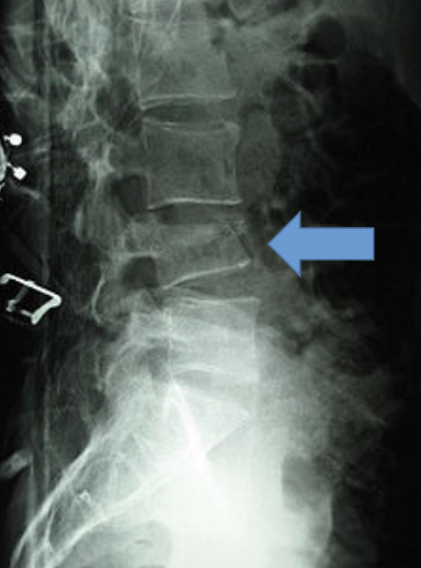 <p>What type of fracture is this? (Bonus points for full explanation)</p>