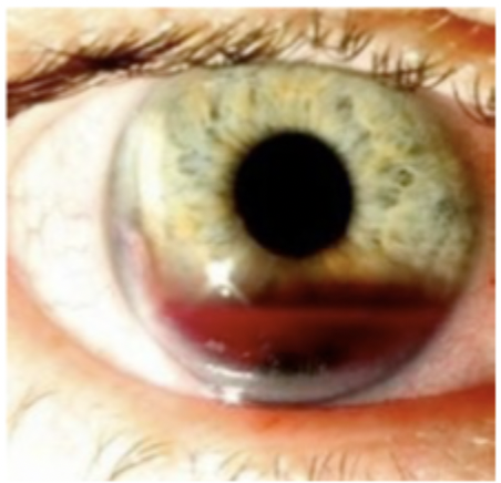 <p>Patient presents to the ER after an elastic band popped back in her face. Patient reports vision loss and eye pain. Patient reports nuasea/vomiting. On a physical exam, you note anisocoria and iridodialysis, as well as blood in the anterior chamber and increased IOP. What’s our treatment plan?</p>