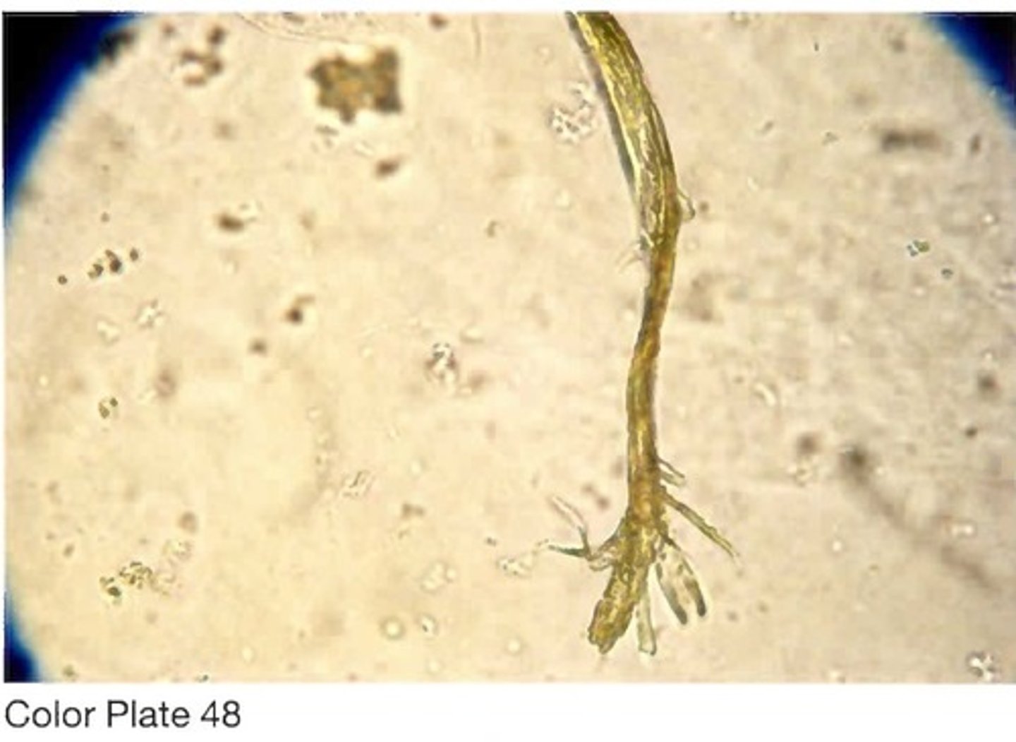 <p>D. Fiber artifact</p>