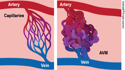 <p>Arteriovenous malformation pathology</p>