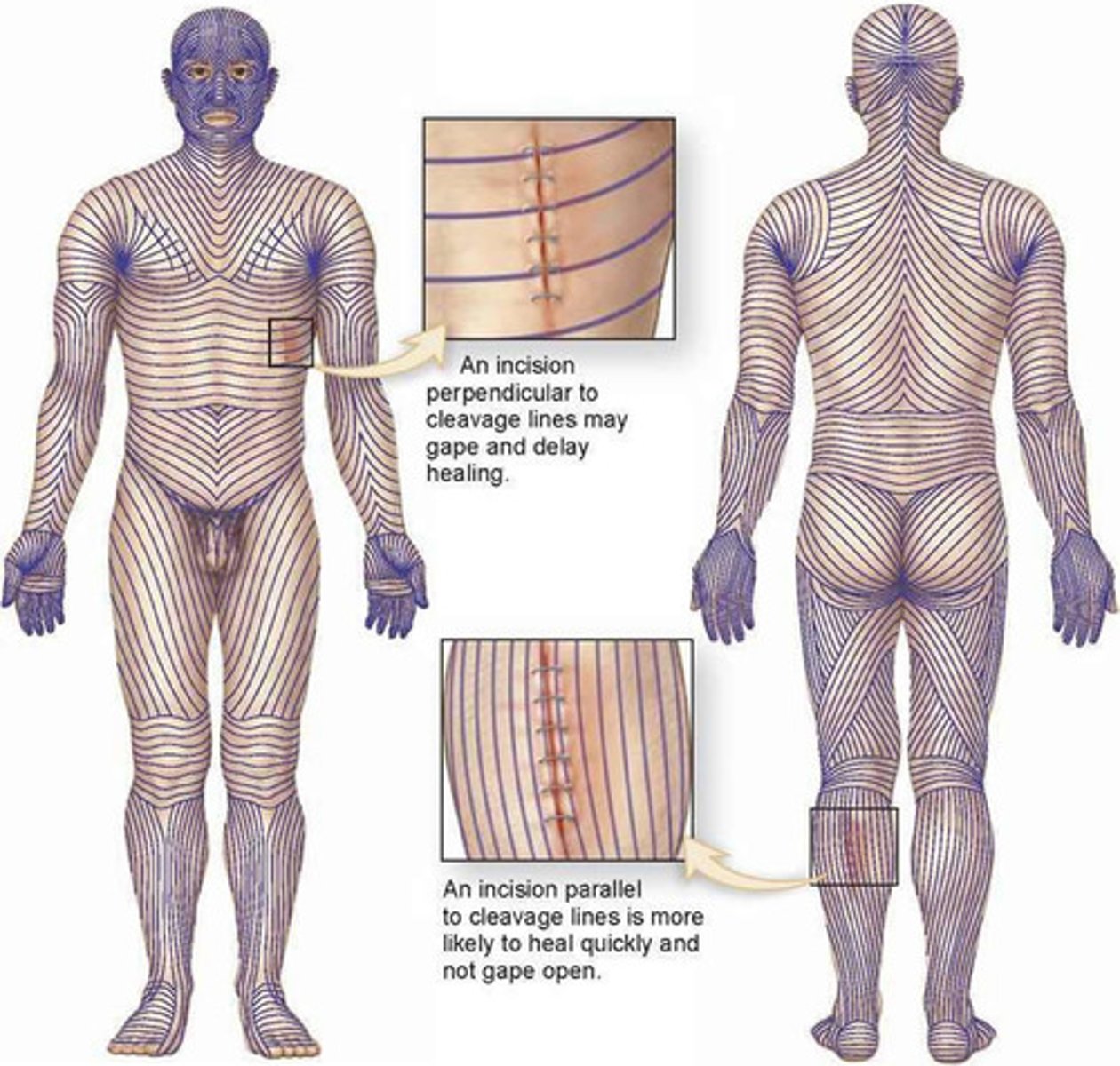 <p>1) cleavage lines</p><p>2) flexture lines - around joints</p>