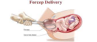 <p>used to assist in the delivery of the fetal head</p>