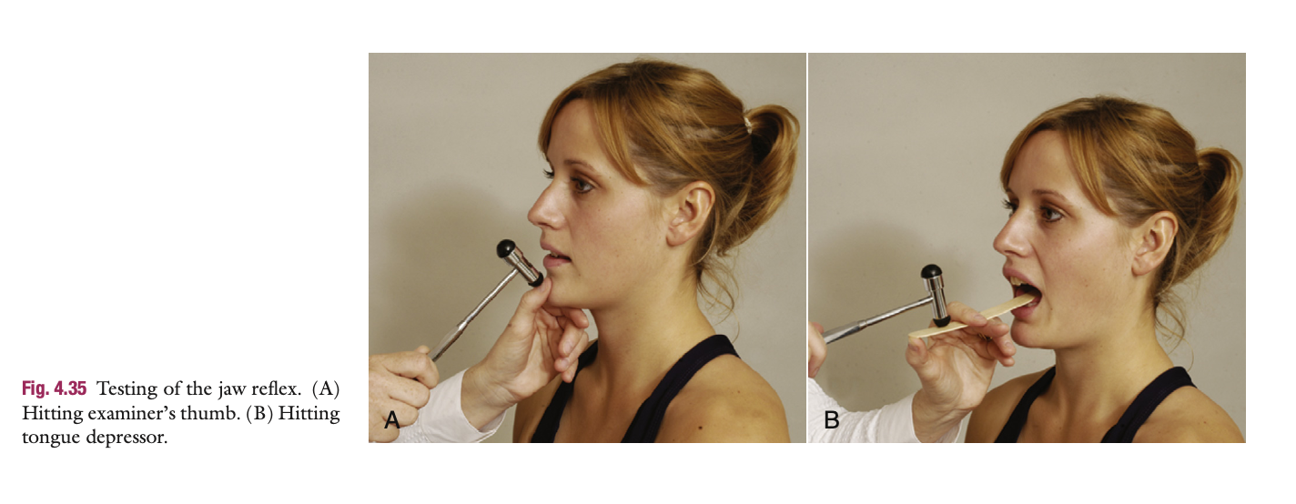 <p>Jaw Reflex (TMJ Reflex)</p><ul><li><p><strong>Testing method</strong>:</p><ul><li><p>The examiner places their thumb or finger on the patient's chin while the mouth is relaxed and open in the resting position.</p></li><li><p>The patient is asked to close their eyes to prevent tension from visual stimuli (e.g., seeing the hammer).</p></li></ul></li><li><p><strong>Execution</strong>:</p><ul><li><p>The examiner taps the thumbnail with a neurological hammer to elicit the reflex.</p></li></ul></li><li><p><strong>Response</strong>:</p><ul><li><p>The reflex causes the mouth to close, testing the function of <strong>cranial nerve V (CN V)</strong>.</p></li></ul></li></ul><p></p>