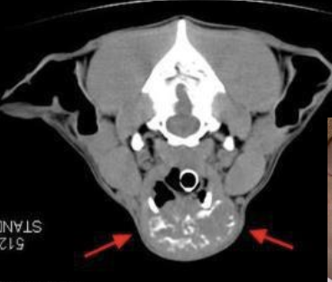 <p>~60% of cases have bilateral disease</p><p>can also have ectopic thyroid neoplasia (can occur anywhere from base of tongue to base of the heart)</p>